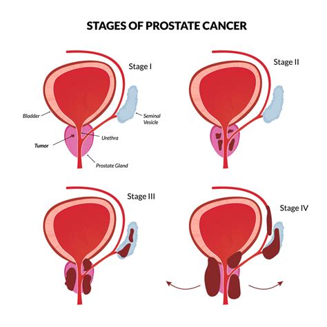 Different people have different symptoms for prostate cancer. Prostate Cancer - Medicentres