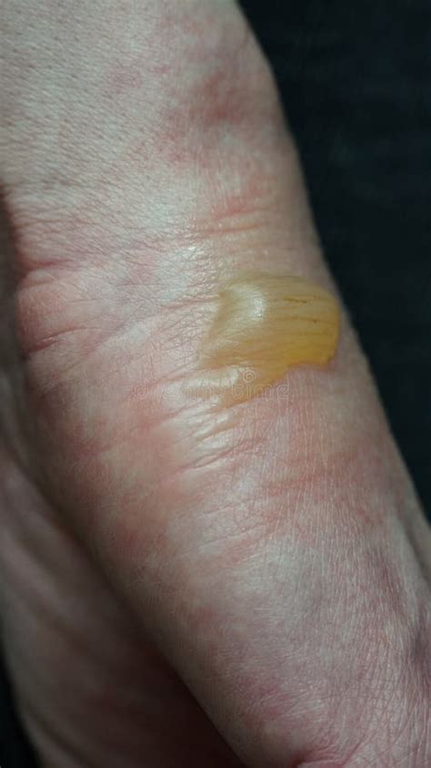 Close Up Of A Woman S Hand With A Blister From A Boiled Water Burn