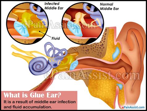 Glue Ear Or Otitis Media With Effusion Omecauses Symptoms Treatment
