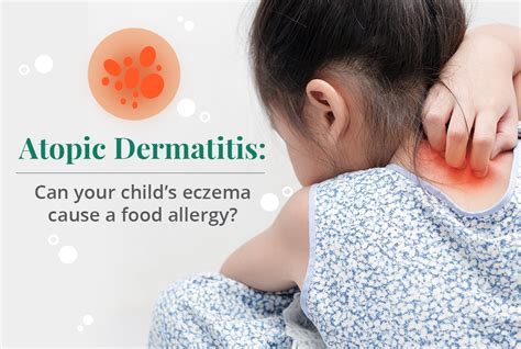 Atopic Dermatitis Can Your Childs Eczema Cause A Food Allergy See