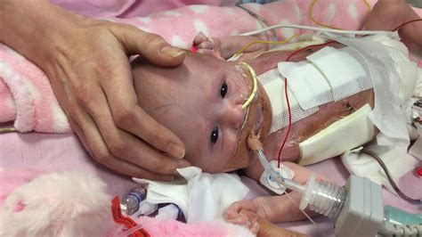 Vanellope Baby Survives After Being Born With Heart Outside Body Uk