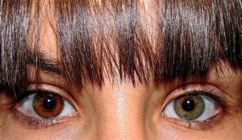 What Is Central Heterochromia With Pictures New Health Guide