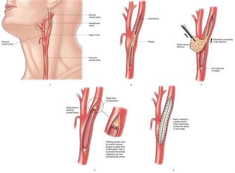 Carotid Endarterectomy Indications Risks Complications Recovery