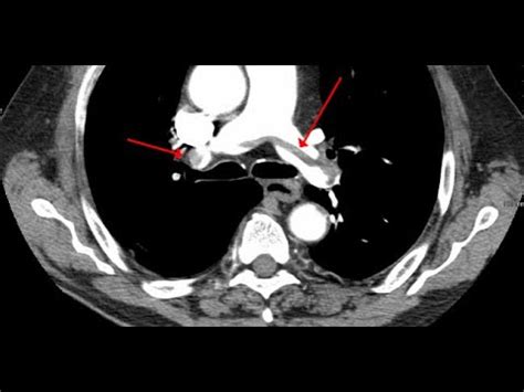 Pulmonary Angiogram Ct Scan Youtube