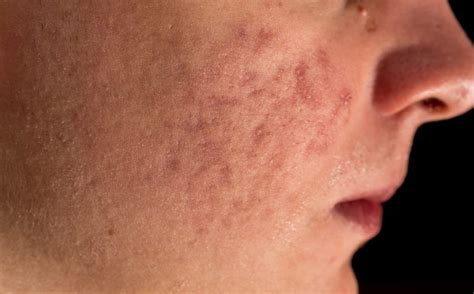 Pin On Acne Scars Pitted