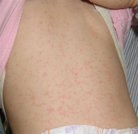 Baby Rash Pictures Causes Treatments Baby Rash Baby Pictures Rashes