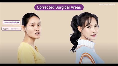Dramatic Plastic Surgery Transformation Seoul Guide Medical YouTube