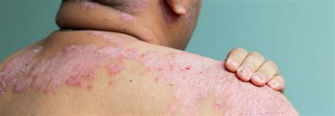 Types And Treatments For Psoriasis