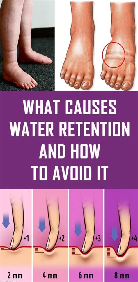 What Causes Water Retention And How To Avoid It Water Retention