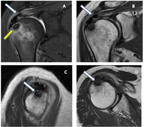 Figure From Mri Findings In Intraosseous Extension Of Calcific Supraspinatus Tendonitis