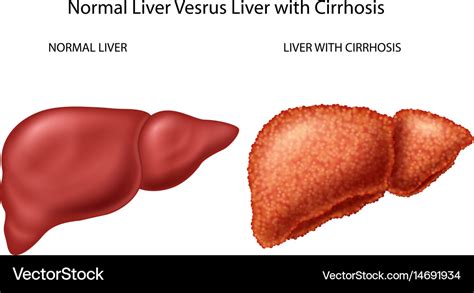 Normal Liver Versus Liver With Cirrhosis Vector Image
