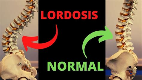 Lordosis Correction Exercises 2 Stretches 6 Exercises Youtube