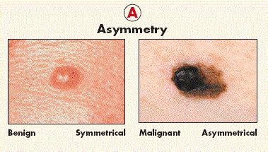 Melanoma is the most serious type of skin cancer. What Does Melanoma Look Like? | New Health Advisor
