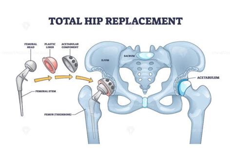 Total Hip Replacement Surgery With Acetabular Prosthesis Outline