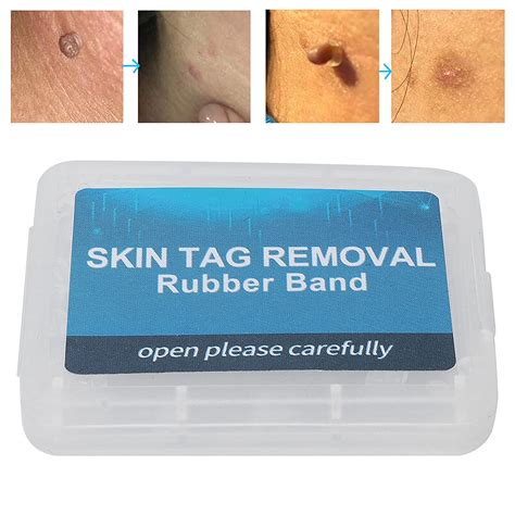 buy tag removal rubber bands skin tag removal remover skin care tools for body face online at