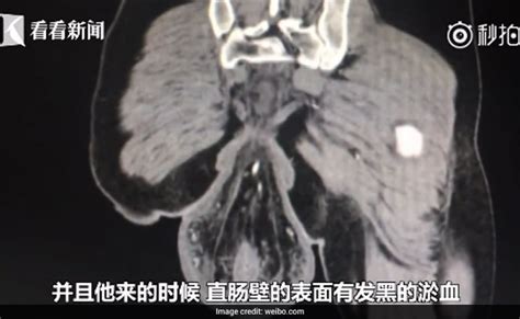 China Mans Rectum Fell Out Of Body After Sitting On The Toilet For 30