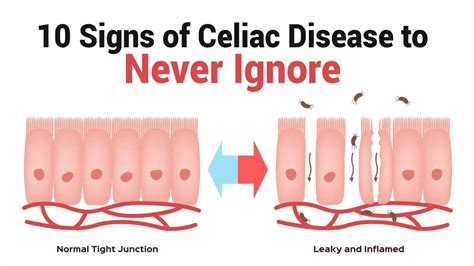 Celiac Disease Symptoms Rash