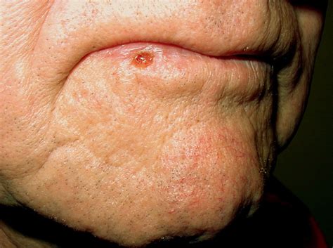 Because basal cell carcinomas and squamous cell carcinomas rarely spread beyond the skin, a biopsy and microscopic examination often is the only test needed. Warning Signs and Symptoms of Non-Melanoma Skin Cancer ...