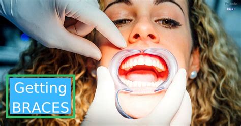 Getting Braces What You Need To Know Step By Step