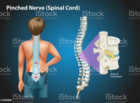 Diagram Showing Pinched Nerve In Human Stock Illustration Download