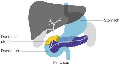 Magnetic resonance imaging (mri) scans produce detailed images of the organs and tissues in the body. Stent for a blocked duodenum - Pancreatic Cancer UK