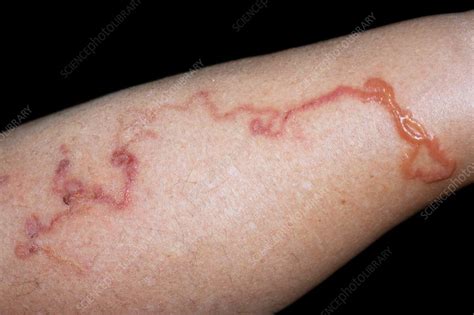 Cutaneous Larva Migrans Infection Stock Image C0298986 Science