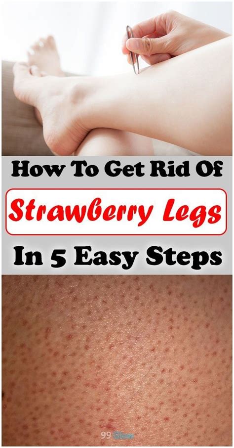 How To Get Rid Of Strawberry Legs In 5 Easy Steps Strawberry Legs