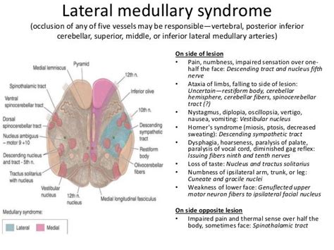 Brainstem Stroke Syndromes Ppt