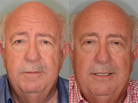 Houston Patient Sought Brow Lift And Upper Blepharoplasty