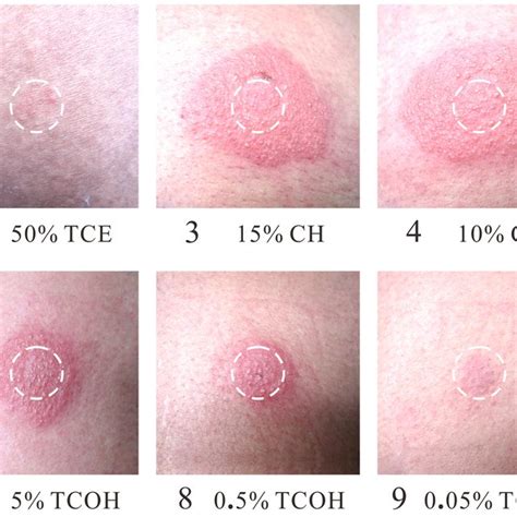 Results Of The Skin Patch Test Among 19 Convalescents With Ths