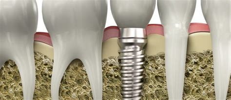 How Quickly After A Tooth Extraction Can I Get A Dental Implant
