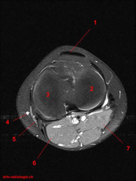 This webpage presents the anatomical structures found on knee mri. Atlas of Knee MRI Anatomy - W-Radiology