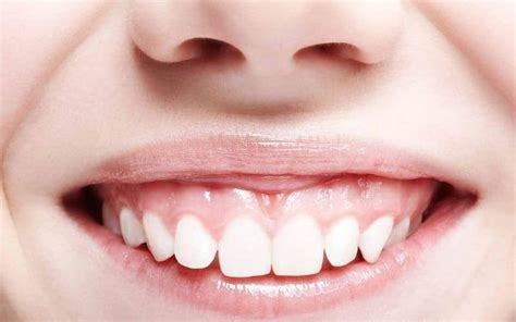 How To Fix A Gummy Smile Wilkinson Orthodontics Gold Coast