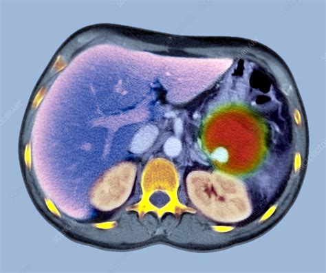 Pancreatitis CT Scan Stock Image M240 0481 Science Photo Library