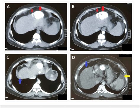 Triphasic Ct Abdomen At One Month Follow Up After Tace Showing Two