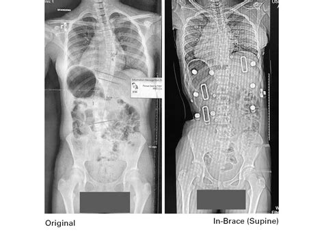 Spinal Technology Providence Nocturnal Scoliosis Orthosis