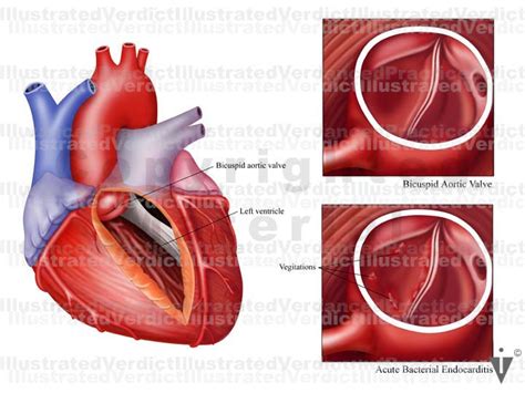 Stock Heart Heart Valves — Illustrated Verdict