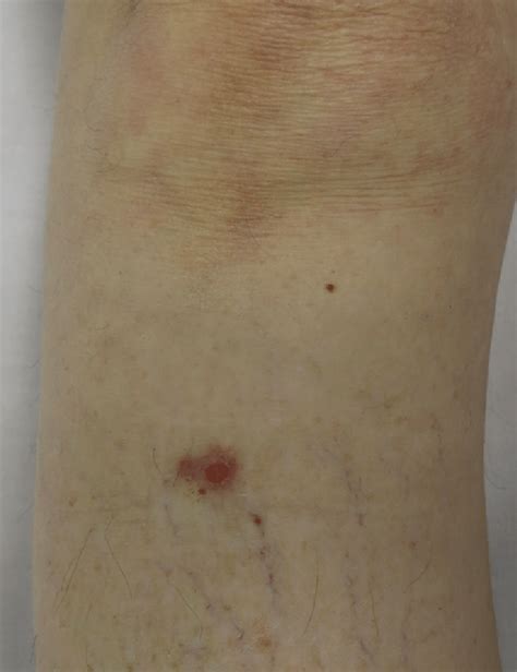 The Lesion Is Located On The Right Leg Just Below The Right Knee It