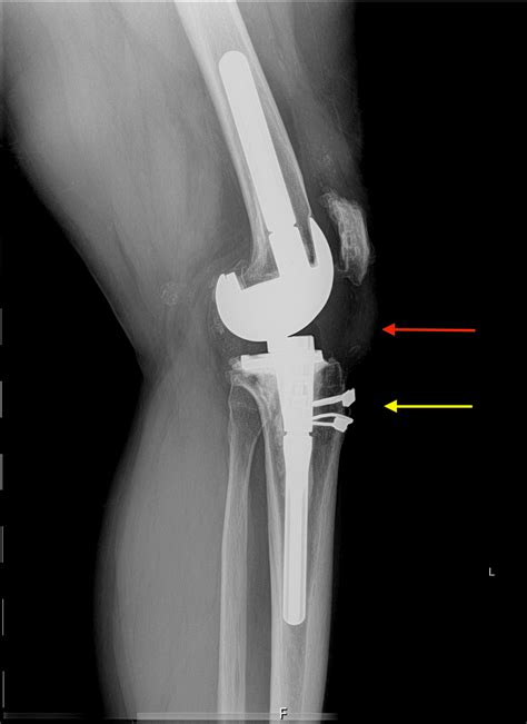 Cureus Bilateral Patellar Tendon Rupture Following Total Knee