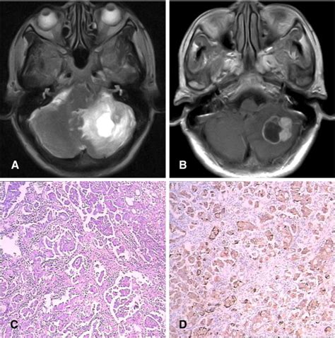 Mri Findings Of Choroid Plexus Tumors In The Cerebellum Clinical Imaging