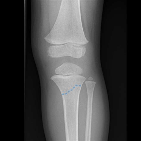 Proximal Tibial Fracture Image