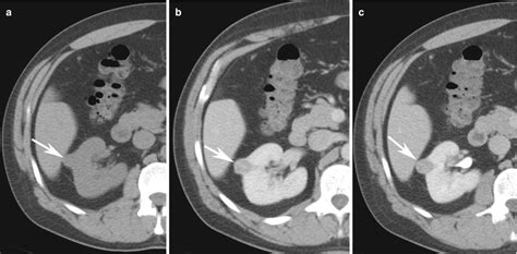 In Renal Cell Carcinoma Radiology Key