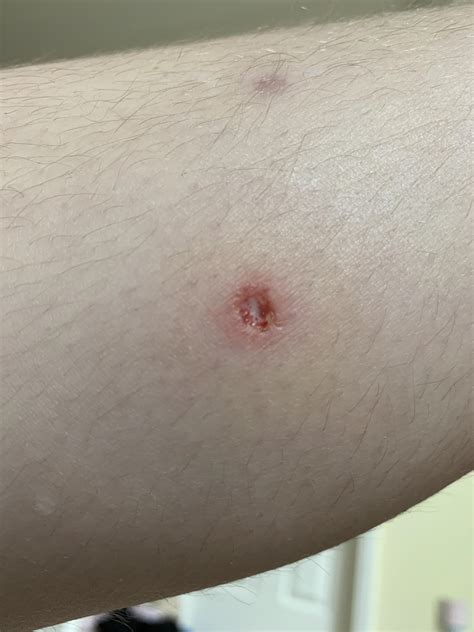 Just Picked A Scab And Saw This Can Some Please Tell Me What It Is R