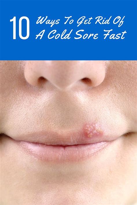 10 Ways To Get Rid Of A Cold Sore Fast Cold Sore Healing Cold Sore