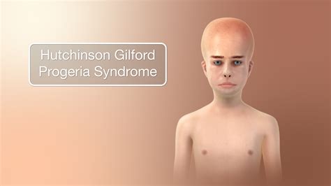 Hutchinson Gilford Progeria Syndrome Depicted Using Medical Animation