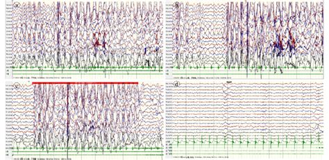 Eeg Results Of Case 1 A Before Treatment Interictal Sleep Veeg