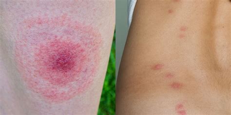 These Pictures Will Help You Id The Most Common Bug Bites This Summer