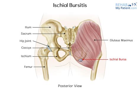 Ischial Bursitis Rehab My Patient Ischial Bursitis Bursitis