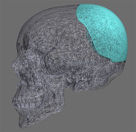 Female Custom Skull Implant Design For Flat Back Of Head Design Side