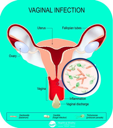 Chronic Bacterial Vaginosis Holistic Treatment Dr Lalezar